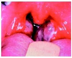 tonsillitis - This is a picture of a child's throat who has tonsillitis.