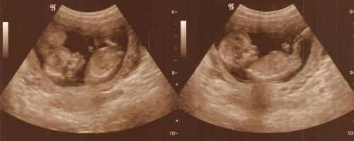 New Life - Life at the beginning stages. 14 weeks gestation.