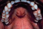 Torus - This patient of mine had a hard bony growth called a torus.