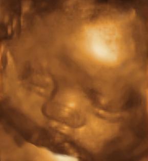 3 dimension echo - Its amazing what a technology can do. She was 32 weeks old in my tummy