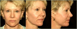 Face Lift - Would you get a face lift? Face Lift - Would you get a face lift?