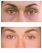 Dark Circles - eyes with dark circles and without it see how much it matters