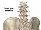 osteoarthiris  - arthiritis - brittling of bones