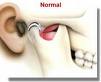 tmj - Tmj is the joint that connect to the jaw and the skull.