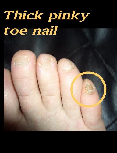Thick Toe Nail - Picture of a thick toe nail.