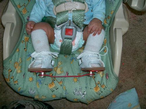 dennis brown bar - My son was born with bilateral clubfoot and this is his brace. It isn't at all what I expected.