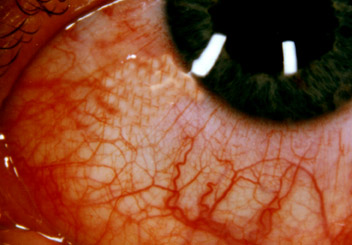 red eye - red eye, irritated
