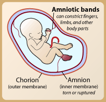 Amniotic Band  - Amniotic Band in Pregnancy