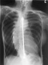 x-ray  - x-ray of a person with scoliosis
