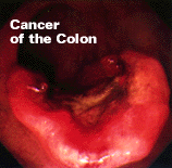 Cancer - What about colon cancer? Do you know about this type of cancer? I really don't know but trying to know about it. Check out the picture and comment upon it!