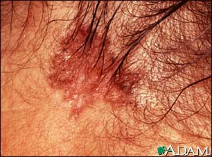 Cancer - The skin cancer is appear as a 2 or 3 centimeter skin spot. The tissue has become destroyed (forming an atrophic plaque). There is a brownish color because of increased skin pigment (hyperpigmentation) and a slightly elevated, rolled, pearl-colored margin. This growth is located along their hair line. Check out the picture and comment it. Hopefully you'll it positively!