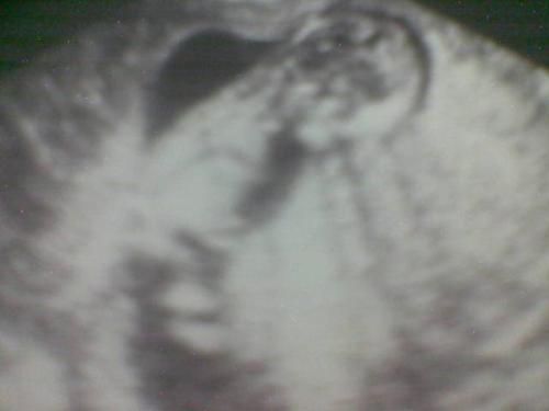 My son - As I sit down to write this, my heart is broken. John Edward was born 5 months(21 weeks-22 weeks) into my pregnancy. This was my second pregnancy, and once again i lost my little boy :(:(:(. My pregnancy was pretty good. I felt great. Of course there's morning sickness 'till the 16th week of my pregnancy. My husband and i did everything for him. I ate healthy foods, took prenatal vitamins. We even go out to check some baby stuff's... It was Nov. 26, 2006, I confronted my husband that i can't feel everything and i was unable to feel my baby's heartbeat. We went to the hospital, and they confirmed that my baby is already dead. How cruel is that??? I didn't do anything bad to other people... Why me? :(:(:(