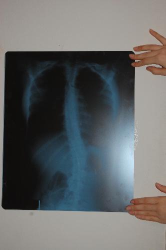 click to enlarge - This is my daughter's XRay from today that we have to take to the specialist.
