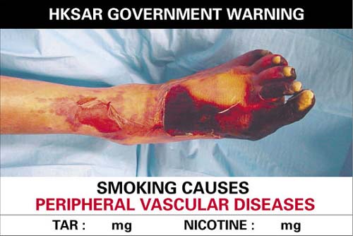 Anti-Smoking - Anti-Smoking advertisment