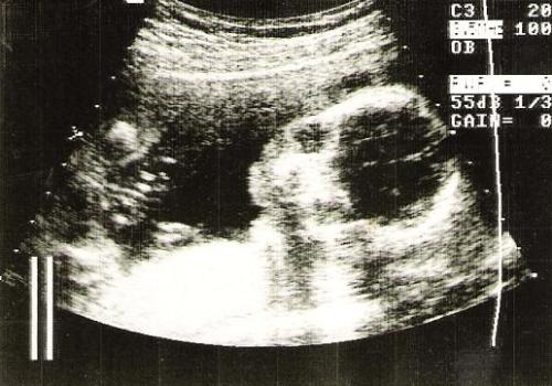 ultrasound of first son - Ultrasound was taken at 21 weeks pregnant. This is when I found out I was having a boy!