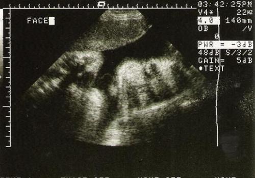 ultrasound of second son - Ultrasound of my second son at 33 weeks pregnant.