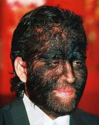 Hairy Face - This is genetics disease..may happen to any body..GOD may help