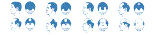 hair loss - hairloss