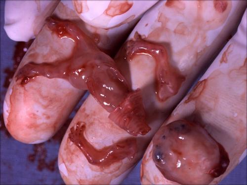 8 weeks baby - this is an eight weeks embryo.. can u think what would be his future if he is still alive? please support anti-abortion
