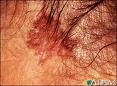 Cancer - Skin Cancer