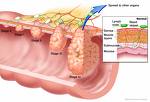 Cancer - Comes in all kinds