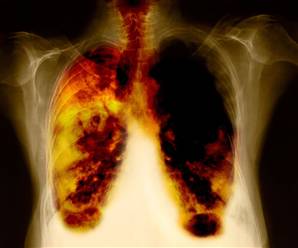 lung cancer - Do you want to have these? I quit smoking a month ago because I don't want to have lung cancer. I regret the first time I smoked. I love myself and I'm taking care of it. I hope you also do.