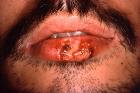 cold sores are painful - remedy to cold sores is there.