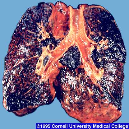 Smoker's Lungs - The picture shows a smoker's lung. Look how the muscles which should ideally be pinkish in color are charred black thanks to the effect of smoke.