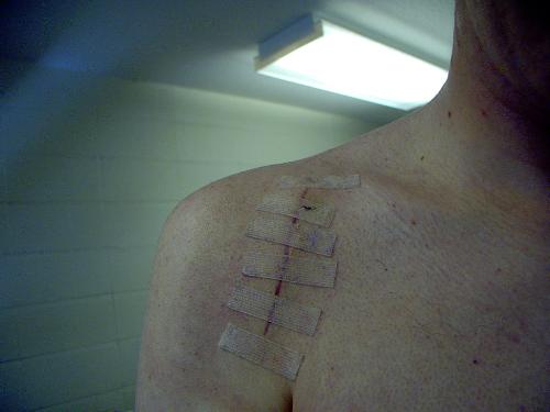 How to get rid of a scar? - Sometimes a scar can hurt emotionally. How can you get rid of it? (The picture is not of my scar), I just provide it as an example.