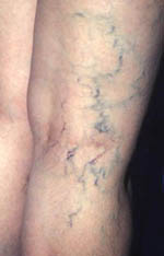 varicose veins - varicose veins or spider veins