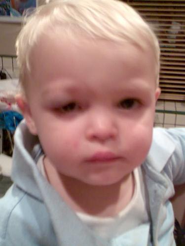 Blackeye - His first blackeye, he fell and hit his eye off the corner of the table.  Here he is feeling sorry for himself. LOL