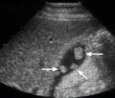 Gallbladder Polyps - Ultrasound findings on Gallbladder Polyps