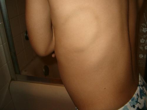 because of a bully - this is a picture of a foot mark on his back that he got from the bully
