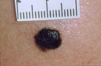 Abnormal mole - Picture of an abnormal mole