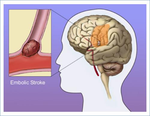 Stroke Attack - An embolic stroke occurs when a blood clot travels from other parts of the body (for example, the heart) to the neck or brain and blocks a blood vessel. The red branch-like structure represents blood vessels and the region of the brain outlined by the small white box is the site of the embolism. The orange region represents the brain areas damaged by the stroke. When a clot forms in a blood vessel in the brain or neck it is called a thrombolic stroke. Embolic and thrombolic strokes are categorized as ischemic stroke. Finally, a blood vessel that is not blocked, but is extremely narrowed, can also cause an ischemic stroke. The blocked or narrowed arteries deprive brain cells of oxygen and nutrients, leading to nerve cell death. 80% of all strokes are ischemic.