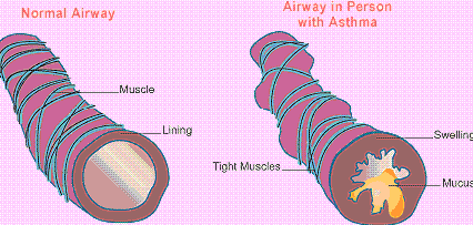 Cure Asthma!! - Air, sun, and water are great healing agents. Regular fasting once a week, an occasional enema, breathing exercises, fresh air, a dry climate, light exercises, and correct posture go a long way in treating the disease.