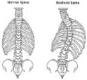 scoliosis - the difference of a normal spine and a spine with scoliosis