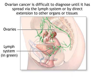 Ovarian cancer - We need to find a way to diagnose this earlier and treat it more effectively.