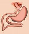 Roux en y - A picture of the roux en y surgery. gastric bypass surgery