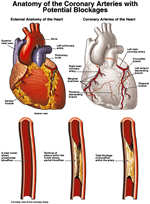 Blockages in Heart - Potential Blockages of the heart which can lead to heart attack.