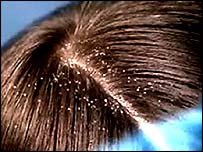 dandruff - The effect of dandruff in the hair/........