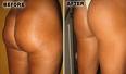 cellulite skin - cellulite before after