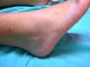 Edema - Swollen ankle caused by edema