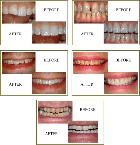 cosmetic dental work - Before and afters of dental work