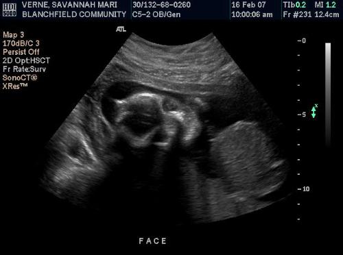 Ultrasound - Here's another ultrasound of Michael. Isn't he a cutie?