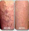 varicose veins - varicose veins are swollen twisted vein