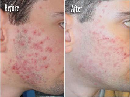 acne - guy with acne. before and after picture.