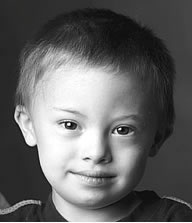 down - trisomy 21 or down syndrome