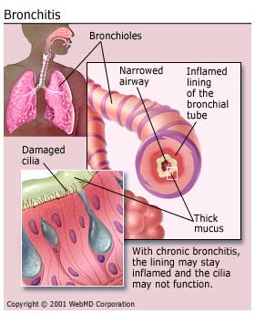 Bronchitis - an image that shows info on bronchitis