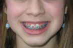 braces - a better smile from braces
